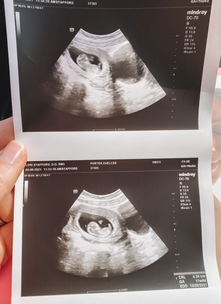 first trimester ultrasound